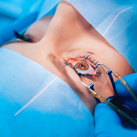 Lasik Service