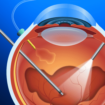 Vitreo-Retina Service